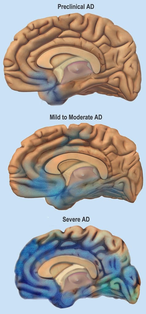 Gates Foundation Launches $1 Million Prize to Accelerate AI Solutions for Alzheimer's Disease
